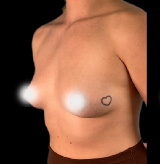 BA Breast 02 BA Breast 02