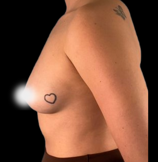 BA Breast 04 BA Breast 04