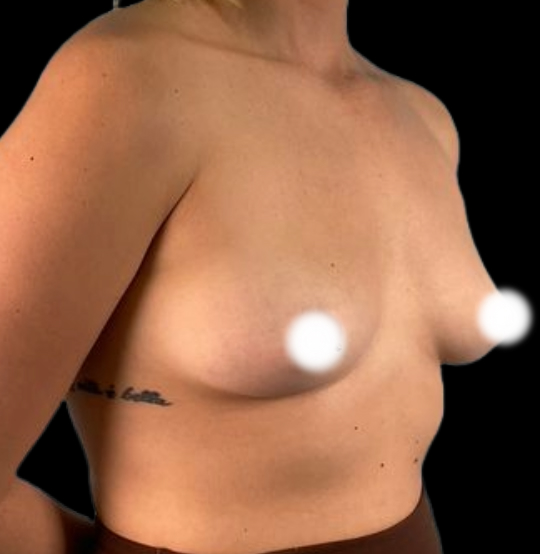 BA Breast 08 BA Breast 08