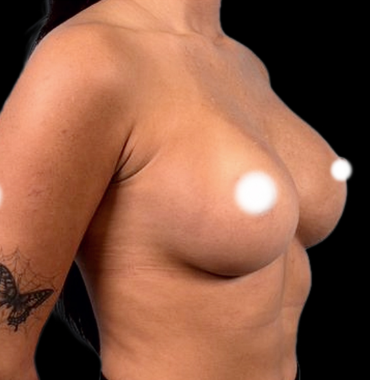 BA Breast 11 BA Breast 11