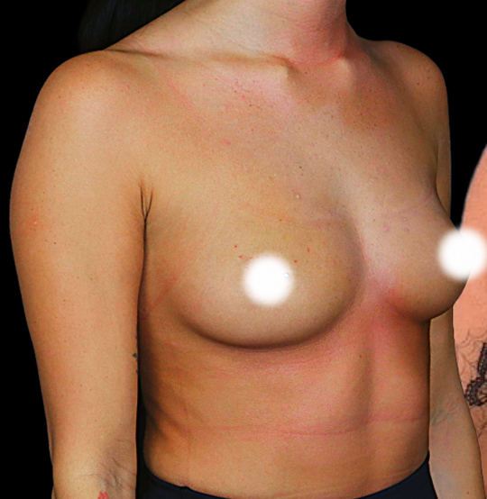 BA Breast 12 BA Breast 12