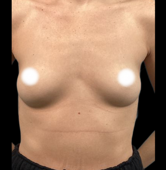 BA Breast 14 BA Breast 14