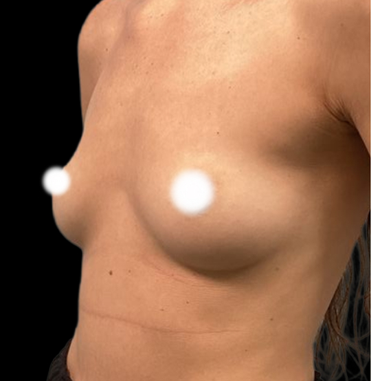 BA Breast 16 BA Breast 16